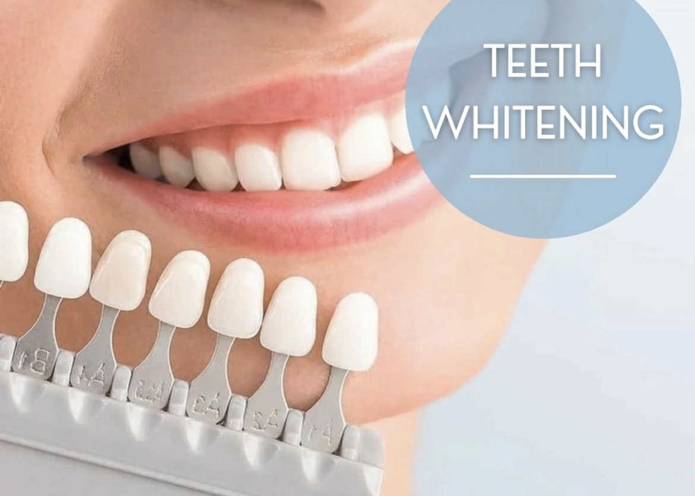  Professional Teeth Whitening by Licensed Dentist in North Macedonia